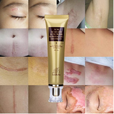 Acne Scar Remover Cream