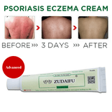 Psoriasis & Eczema Cream